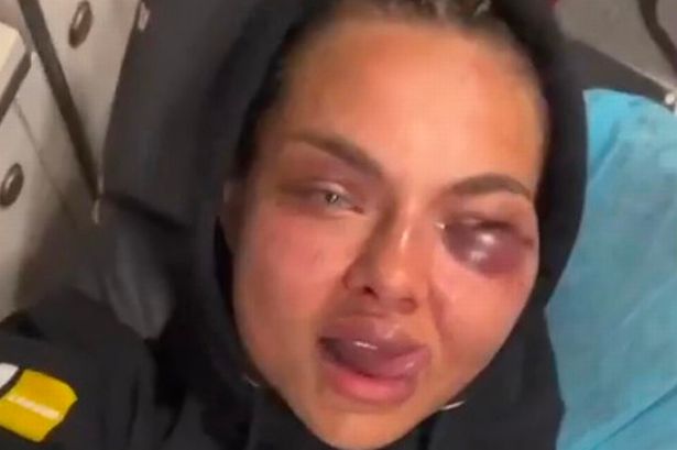 World’s most beautiful MMA star shares brutal injuries – but is still shining on OnlyFans